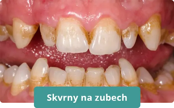 zubní skvrny